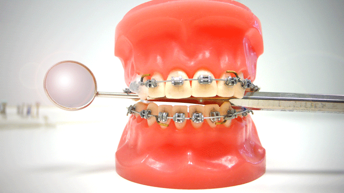 Eine Festsitzende Zahnspange